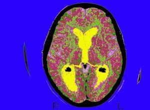  photo n-ALZHEIMER-BRAIN-large300_zps8db44060.jpg